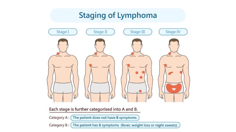 ung thư hạch có di truyền không