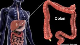 Các dấu hiệu của ung thư đại tràng điển hình nhất