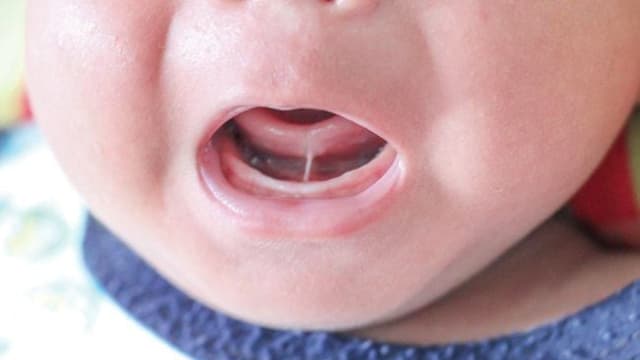 Cắt thắng lưỡi cho bé: Triệu chứng, cấp độ và chi phí phẫu thuật