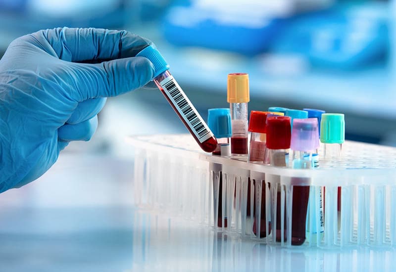 hct thấp trong xét nghiệm máu là gì