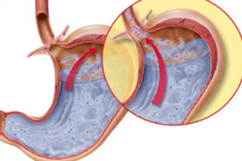 co thắt thực quản có nguy hiểm không