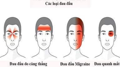 Đau đầu vận mạch điều trị thế nào?