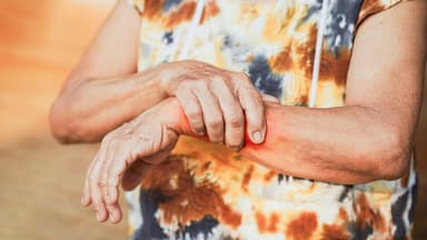 Dấu hiệu bệnh Lupus ban đỏ giai đoạn đầu