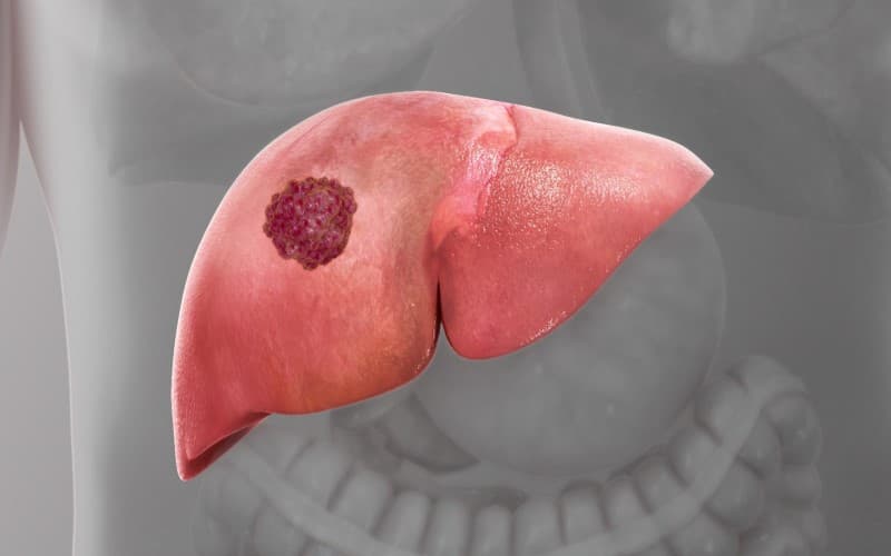 dấu hiệu người ung thư gan sắp chết