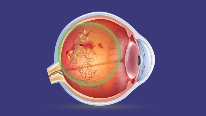 tiểu đường biến chứng vào mắt