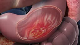 Các dấu hiệu ung thư dạ dày điển hình