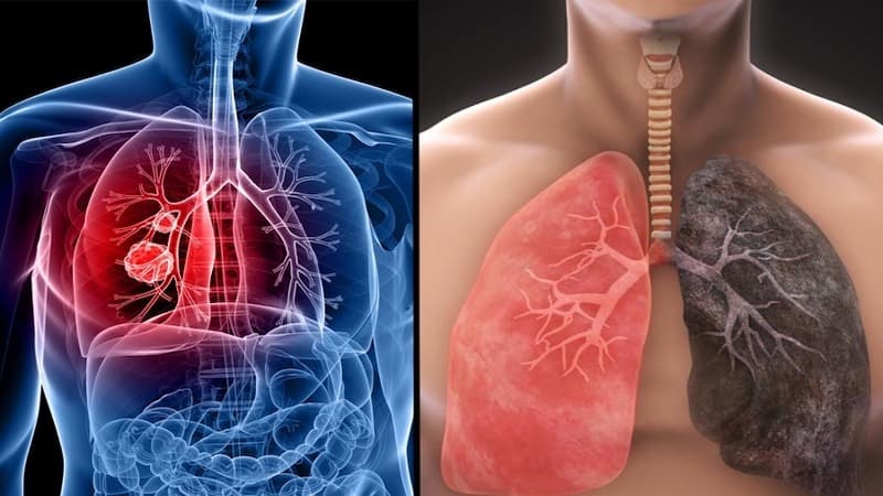 dấu hiệu sắp chết của người bị ung thư phổi