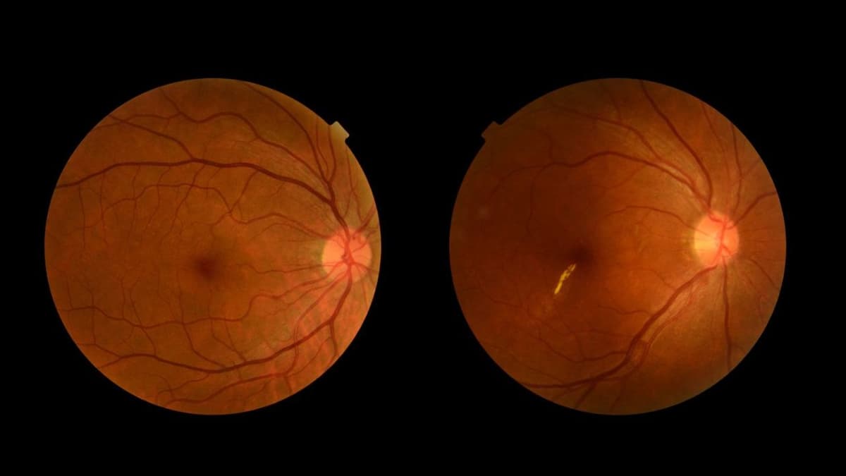 Các phương pháp mới điều trị thoái hóa võng mạc