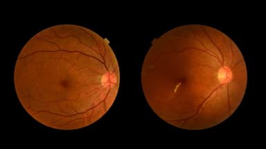 Các phương pháp mới điều trị thoái hóa võng mạc