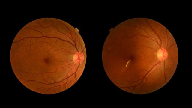 Các phương pháp mới điều trị thoái hóa võng mạc