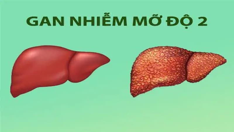 gan nhiễm mỡ độ 2 có chữa khỏi được không