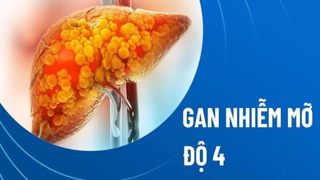 Bị gan nhiễm mỡ độ 4 sống được bao lâu?