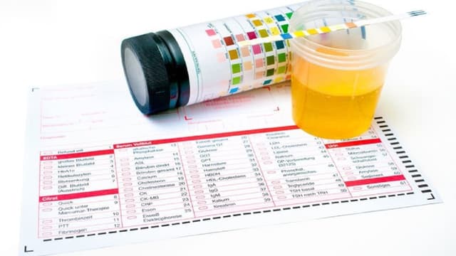 Chỉ số GLU trong xét nghiệm nước tiểu là gì?