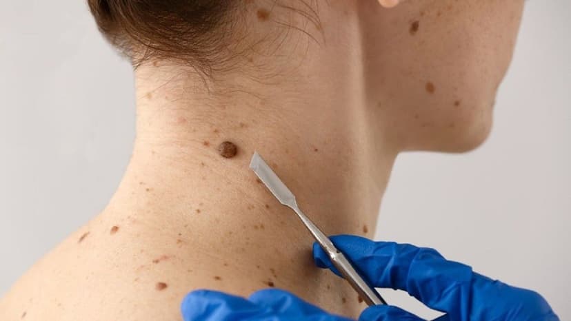 Hình ảnh nốt ruồi bất thường, khối u ác tính và những thay đổi trên da