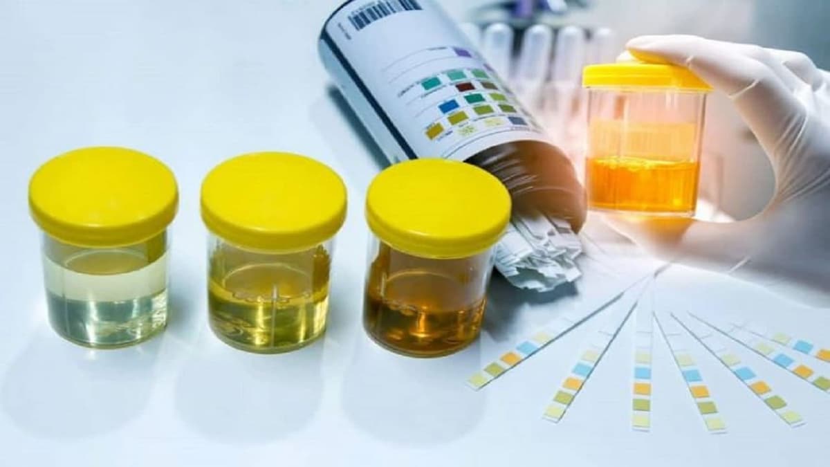 Chỉ số KET trong xét nghiệm nước tiểu là gì?