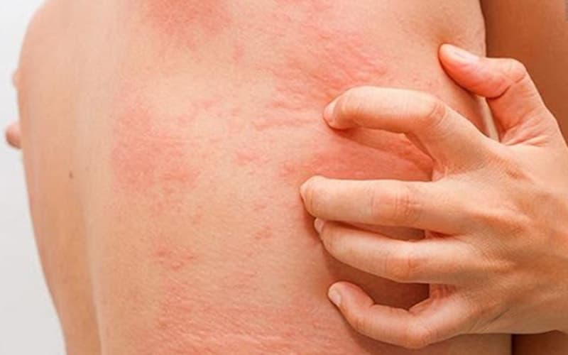 bệnh lupus ban đỏ có ngứa không