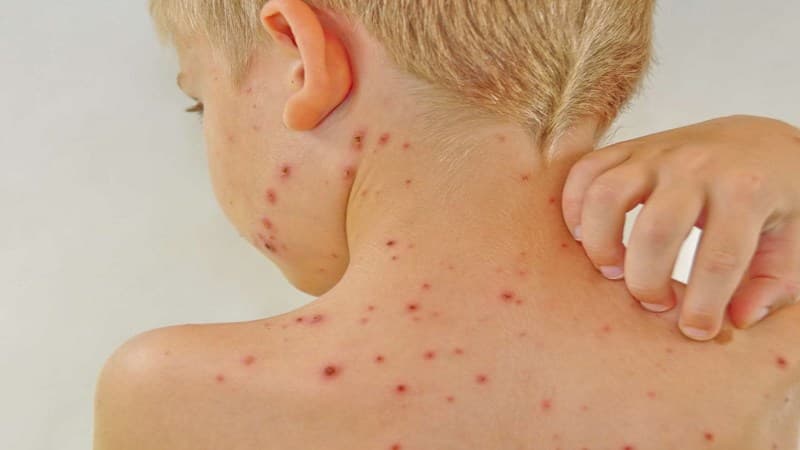 dấu hiệu bệnh Lupus ban đỏ ở trẻ em