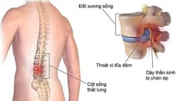 Các lý do bị thoát vị đĩa đệm
