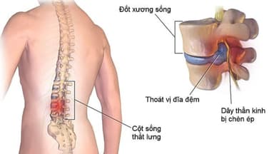 Mổ thoát vị đĩa đệm bao lâu quan hệ được