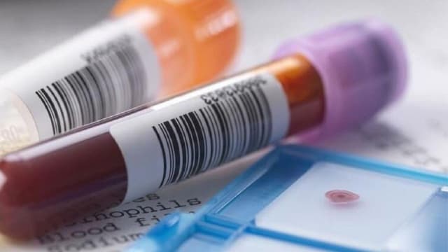 Chỉ số MPV thấp trong xét nghiệm máu là bệnh gì?