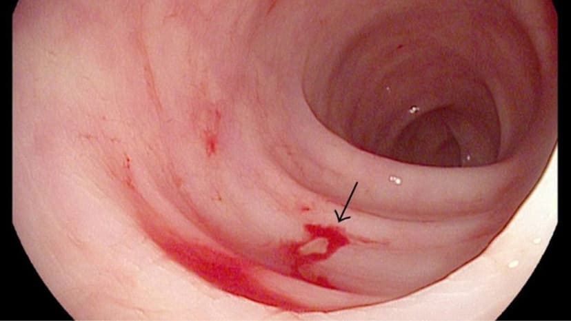 Nguyên nhân chảy máu dạ dày thường gặp
