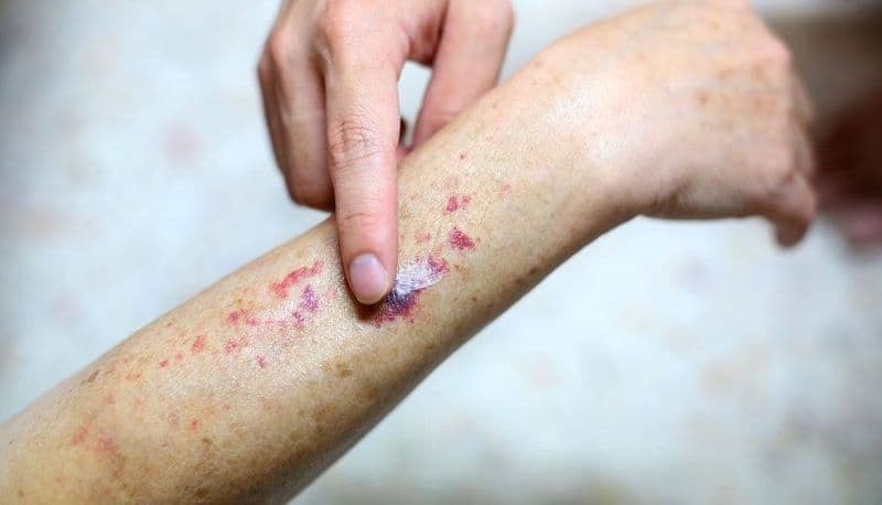 nguyên nhân ung thư máu