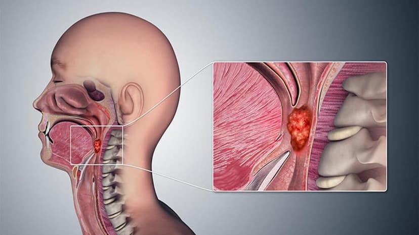 Các nguyên nhân ung thư vòm họng