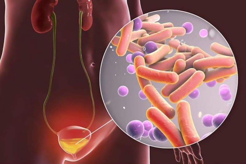nước tiểu có mùi tanh ở nữ
