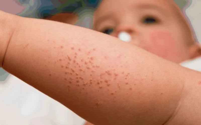 Đặc điểm nhận diện nốt sốt xuất huyết chính xác