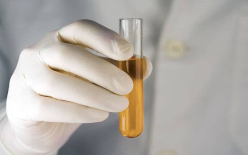 nước tiểu có mùi khai nồng nặc ở trẻ em