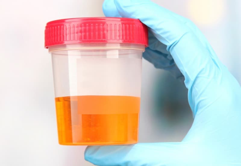 nước tiểu màu nâu đỏ