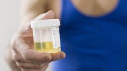Nước tiểu có bao nhiêu màu? Màu gì là tốt nhất?