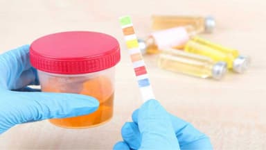 Vì sao nước tiểu màu nâu đỏ?