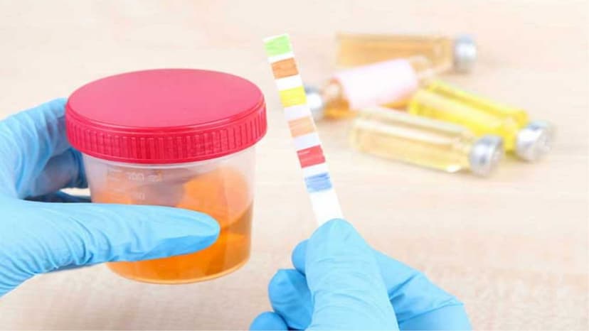 Vì sao nước tiểu màu nâu đỏ?