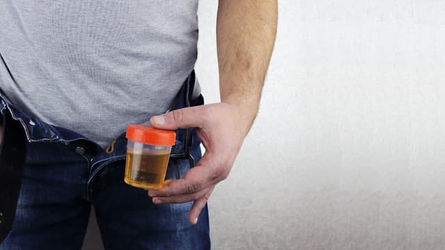 Nước tiểu màu vàng đậm có mùi hôi và khai, có phải bị nhiễm khuẩn?