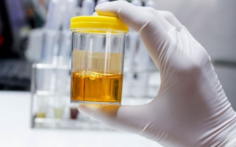 nước tiểu màu vàng đậm có mùi hôi