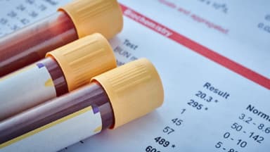 Chỉ số PDW thấp trong xét nghiệm máu là gì?