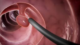 Polyp dạ dày có phải là ung thư không?