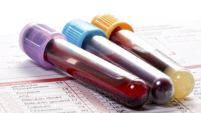 Chỉ số PWD cao trong xét nghiệm máu là gì?