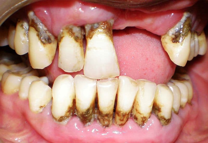 răng bị viêm tủy