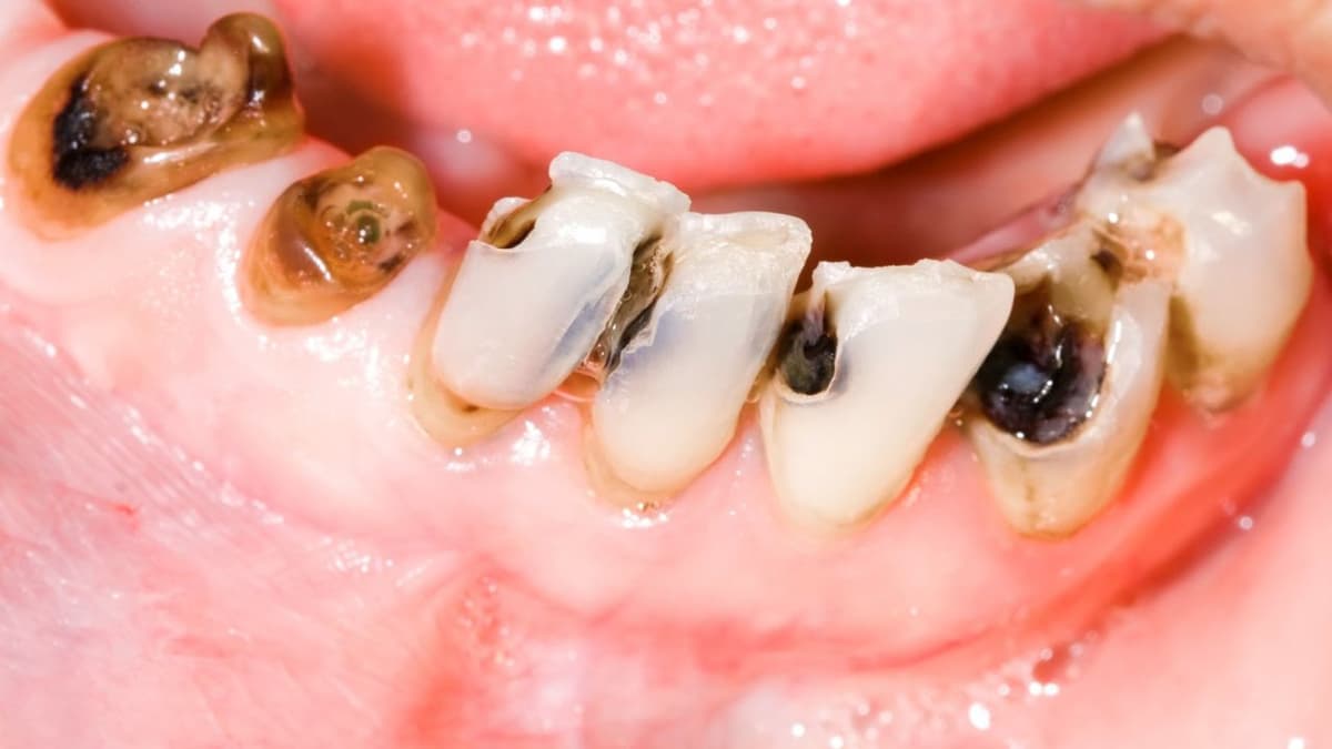 Vì sao răng bị viêm tủy?