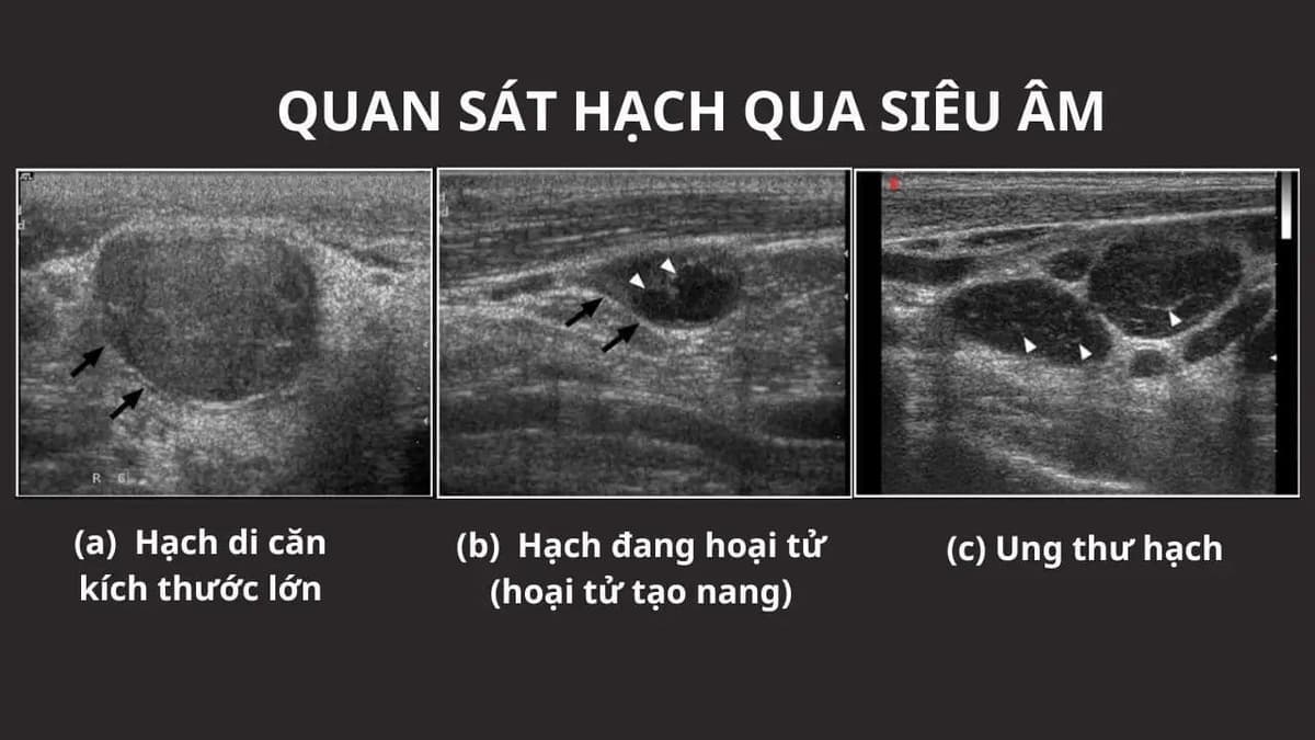Siêu âm cổ có phát hiện ung thư vòm họng không?