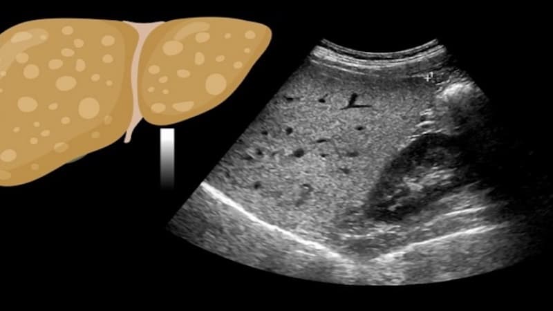 xét nghiệm gì để biết gan nhiễm mỡ
