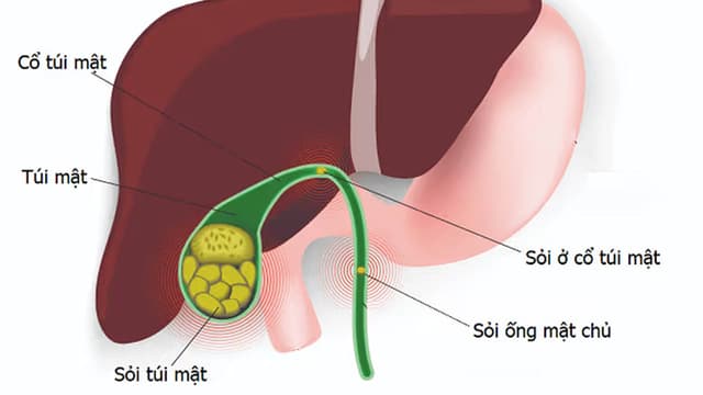 Sỏi túi mật 20mm có nguy hiểm không?