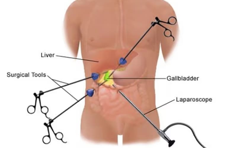 sỏi túi mật 20mm có nguy hiểm không