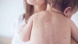 Những triệu chứng sốt xuất huyết ở trẻ em 7 tuổi theo từng giai đoạn