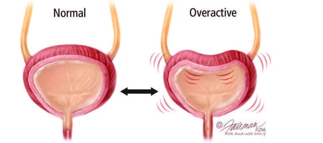 Các thuốc có thể gây ra bàng quang hoạt động quá mức