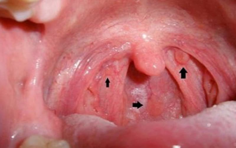 trào ngược dạ dày gây ung thư vòm họng