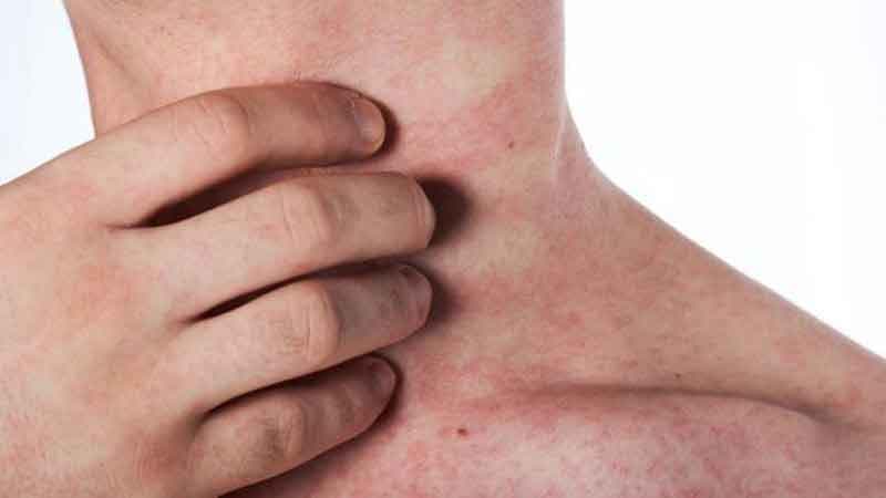 Triệu chứng sốt xuất huyết theo ngày