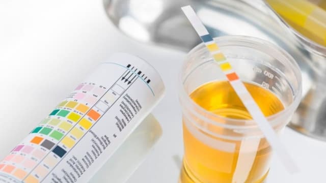 Chỉ số UBG trong xét nghiệm nước tiểu là gì? Mức nào là bình thường?